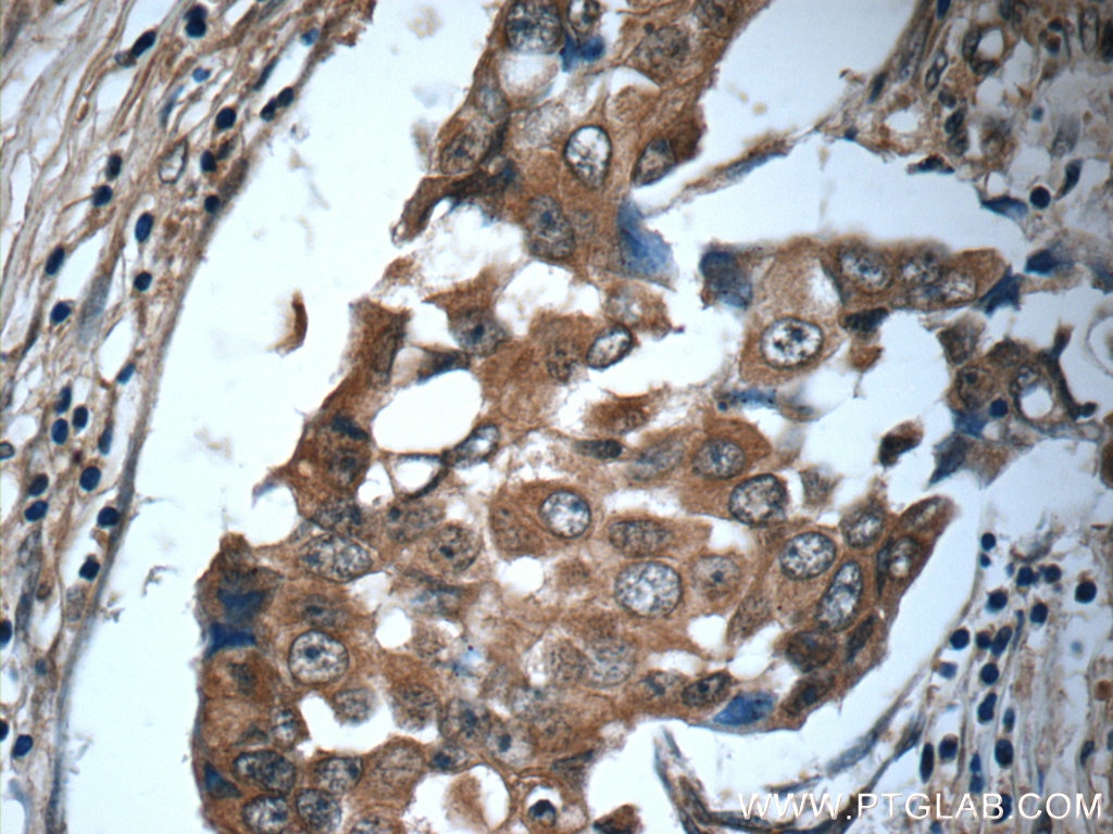 Immunohistochemistry (IHC) staining of human breast cancer tissue using IL-19 Polyclonal antibody (24402-1-AP)
