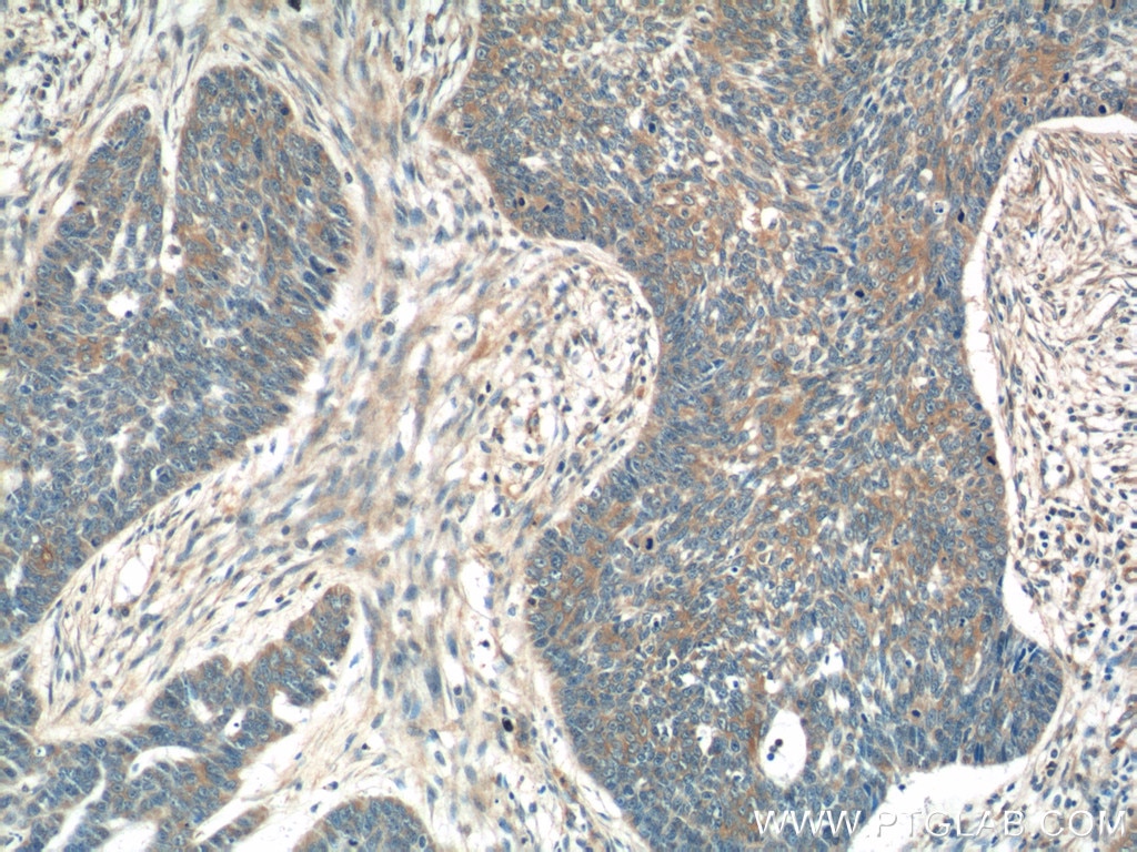 Immunohistochemistry (IHC) staining of human skin cancer tissue using IL-19 Polyclonal antibody (24402-1-AP)
