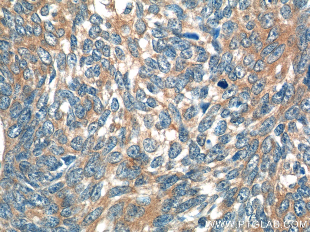 Immunohistochemistry (IHC) staining of human skin cancer tissue using IL-19 Polyclonal antibody (24402-1-AP)