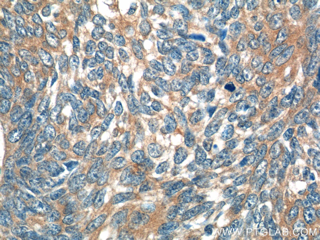 Immunohistochemistry (IHC) staining of human skin cancer tissue using IL-19 Polyclonal antibody (24402-1-AP)