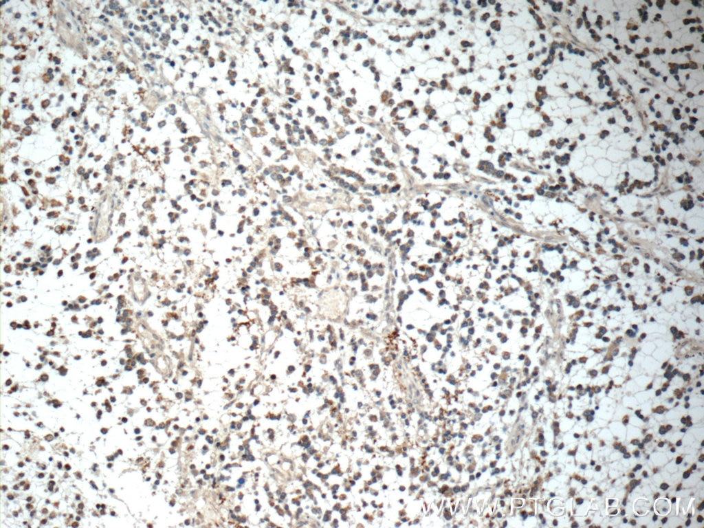 Immunohistochemistry (IHC) staining of human gliomas tissue using IL-1F6/IL-36 Alpha Polyclonal antibody (24173-1-AP)