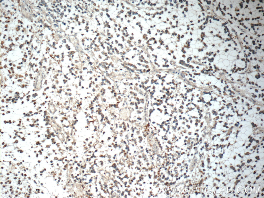 IHC staining of human gliomas using 24173-1-AP