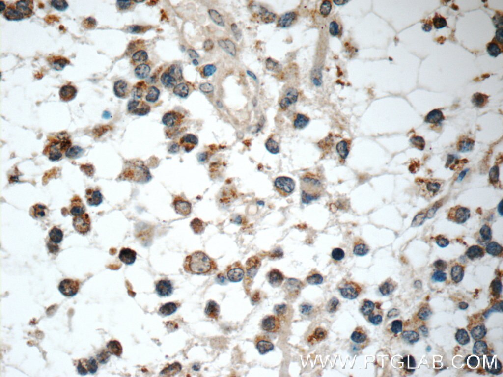 Immunohistochemistry (IHC) staining of human gliomas tissue using IL-1F6/IL-36 Alpha Polyclonal antibody (24173-1-AP)