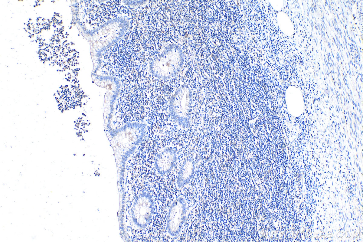 Immunohistochemistry (IHC) staining of human appendicitis tissue using IL-1R1 Polyclonal antibody (27348-1-AP)
