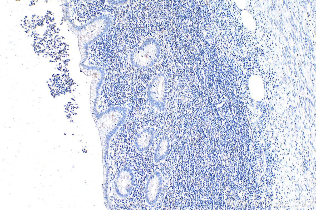 IHC staining of human appendicitis using 27348-1-AP