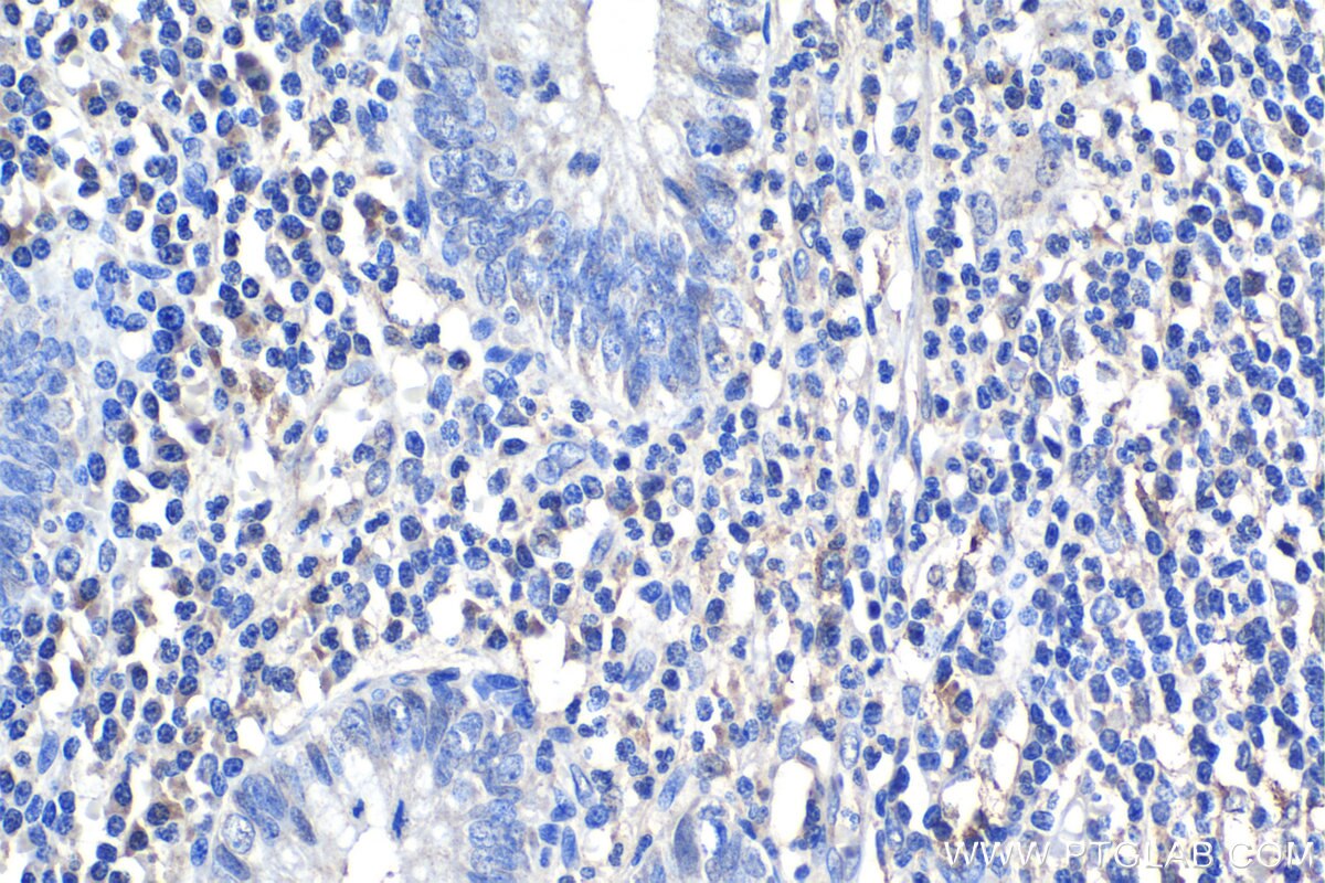 Immunohistochemistry (IHC) staining of human appendicitis tissue using IL-1R1 Polyclonal antibody (27348-1-AP)