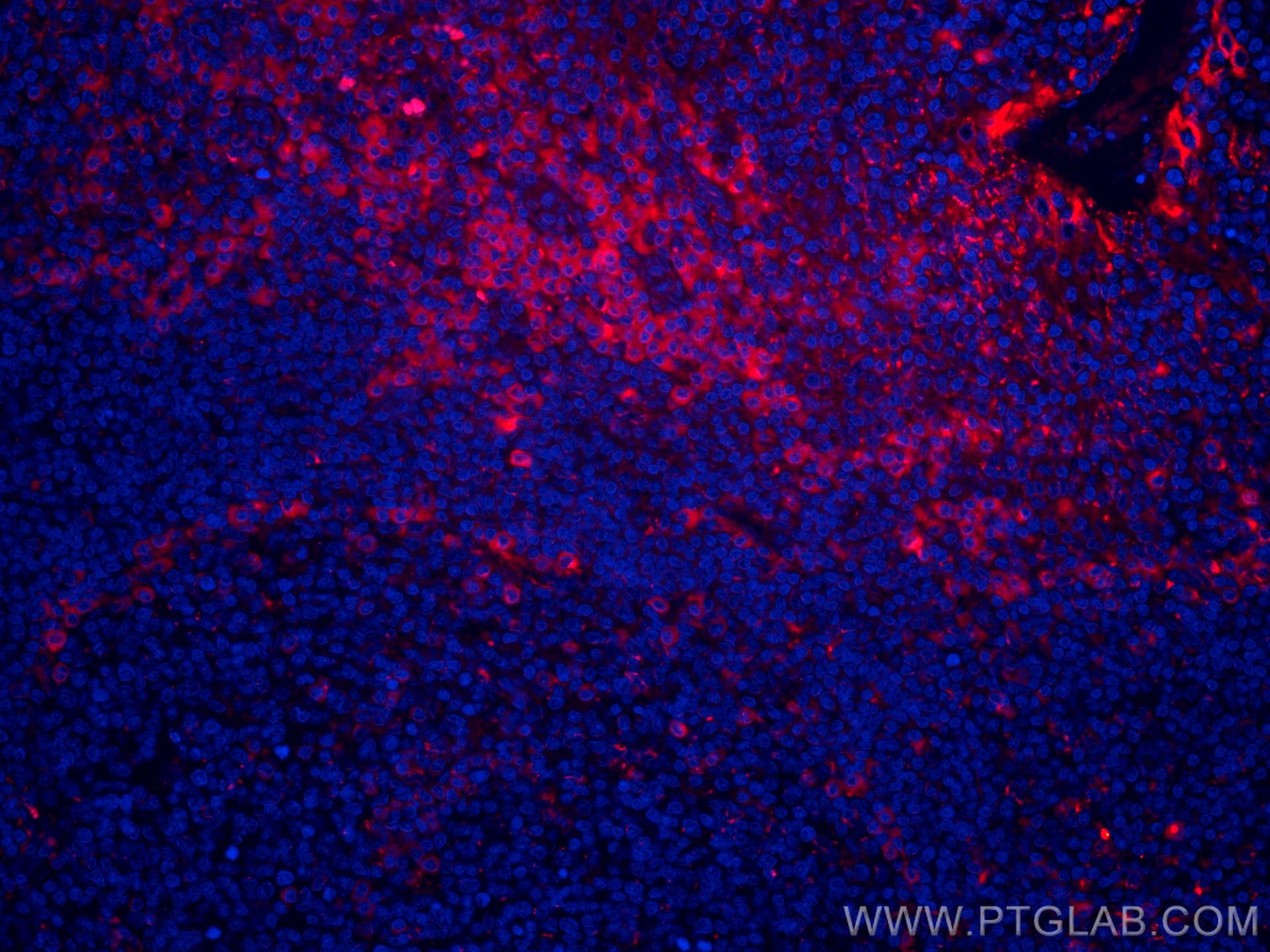 Immunofluorescence (IF) / fluorescent staining of human tonsillitis tissue using CoraLite®594-conjugated IL-2 Monoclonal antibody (CL594-60306)