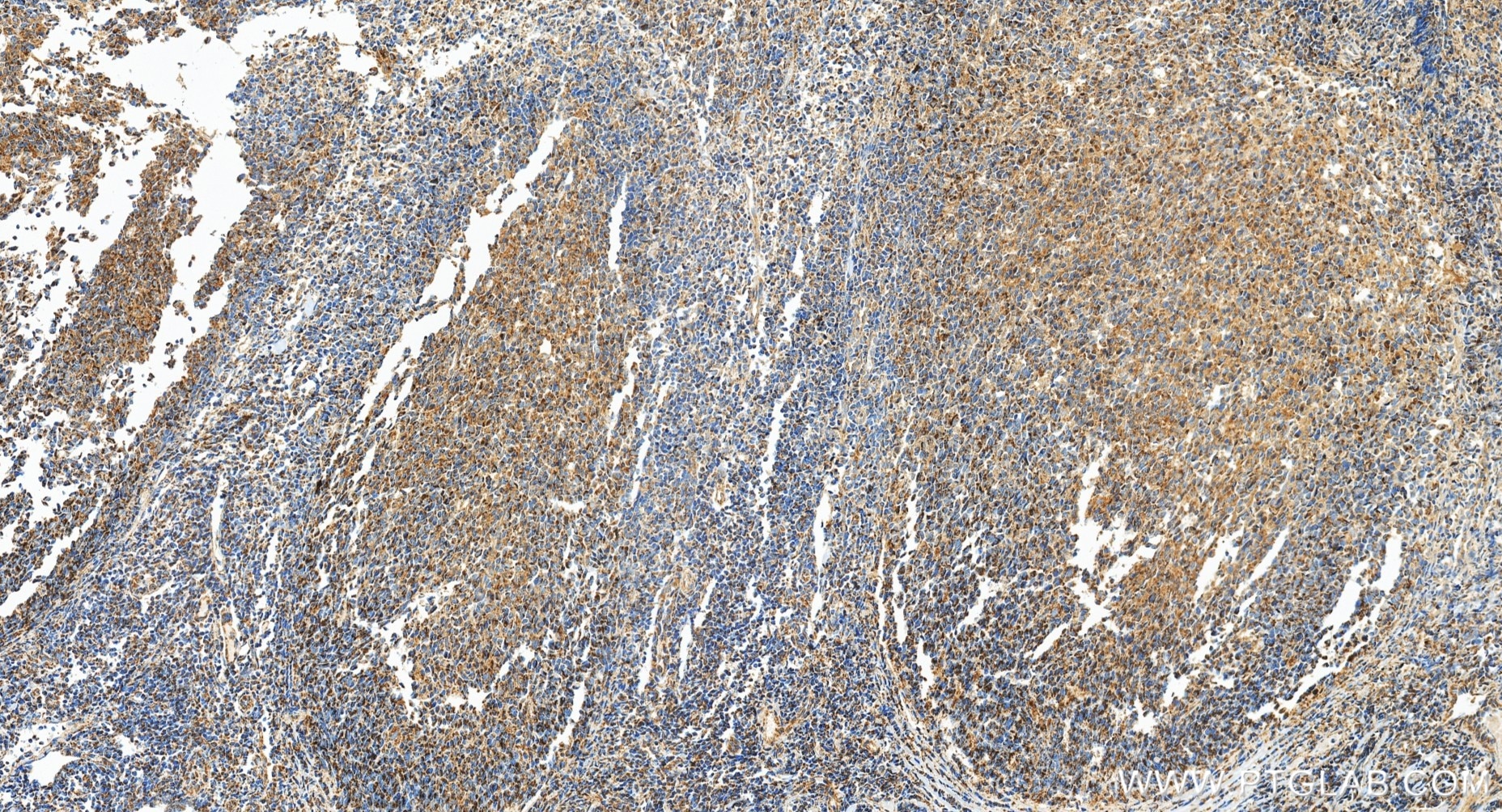 IHC staining of human tonsillitis using 98735-3-RR (same clone as 98735-3-PBS) Immunohistochemistry (IHC) staining of human tonsillitis tissue using Anti-Human IL-24 Rabbit Recombinant Antibody (98735-3-RR)