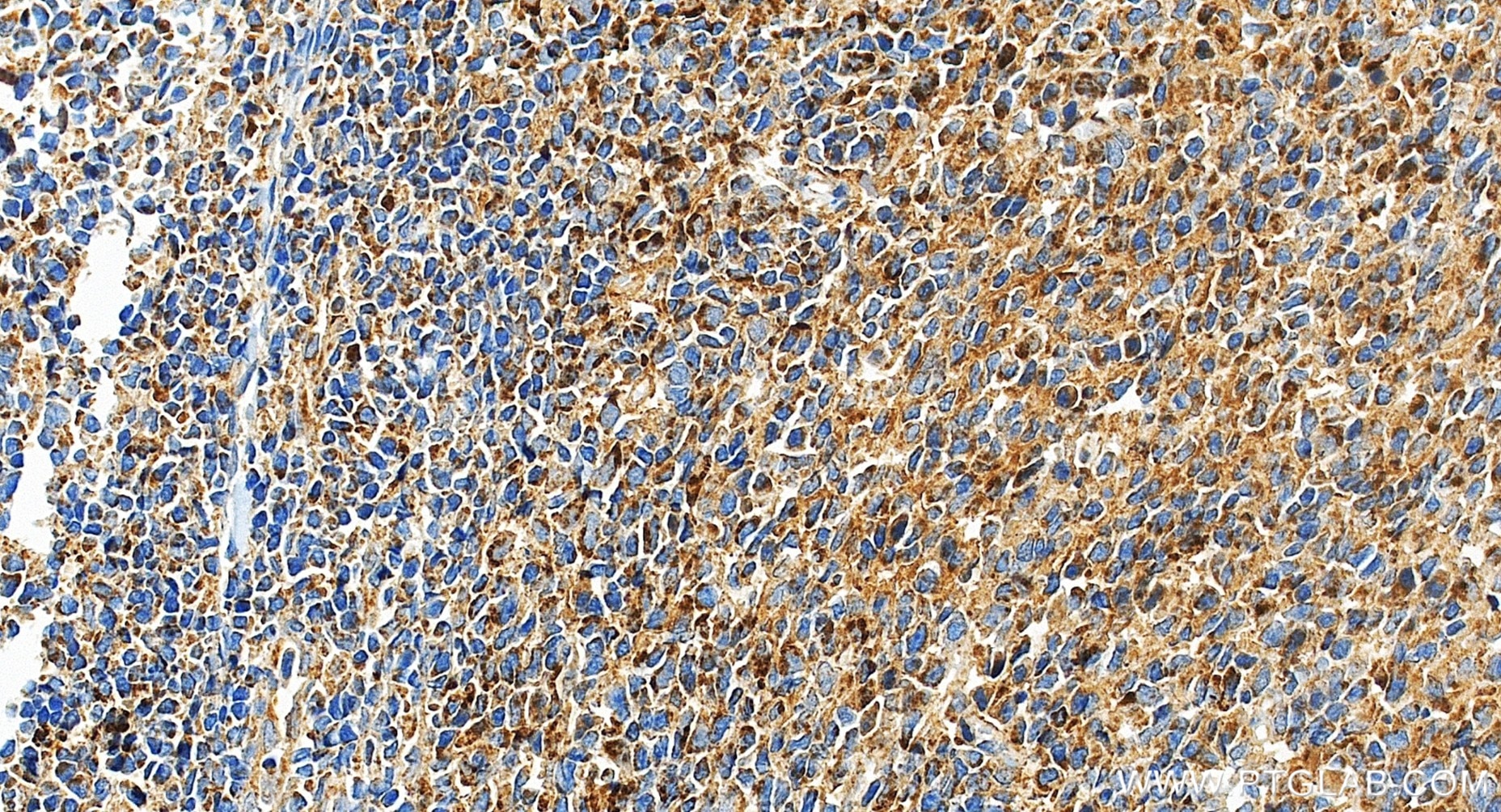 IHC staining of human tonsillitis using 98735-3-RR (same clone as 98735-3-PBS) Immunohistochemistry (IHC) staining of human tonsillitis tissue using Anti-Human IL-24 Rabbit Recombinant Antibody (98735-3-RR)