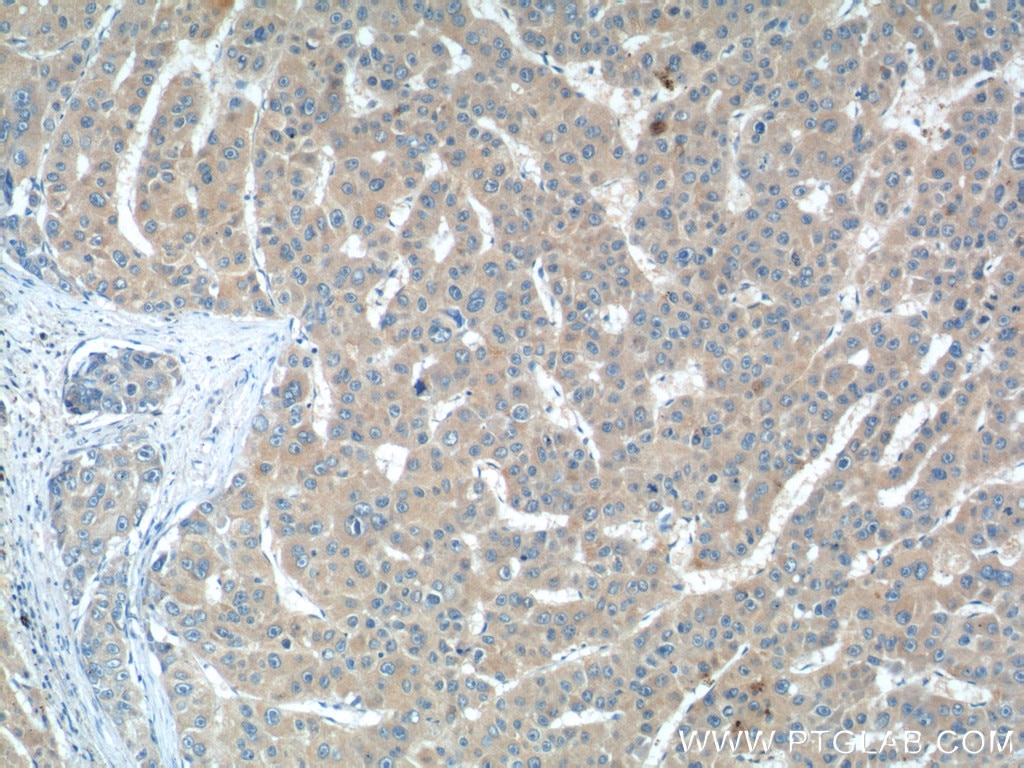 Immunohistochemistry (IHC) staining of human liver cancer tissue using IL-27 Polyclonal antibody (24165-1-AP)