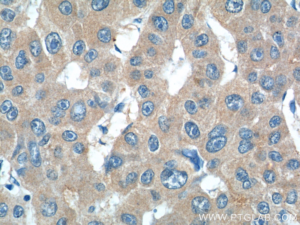 Immunohistochemistry (IHC) staining of human liver cancer tissue using IL-27 Polyclonal antibody (24165-1-AP)