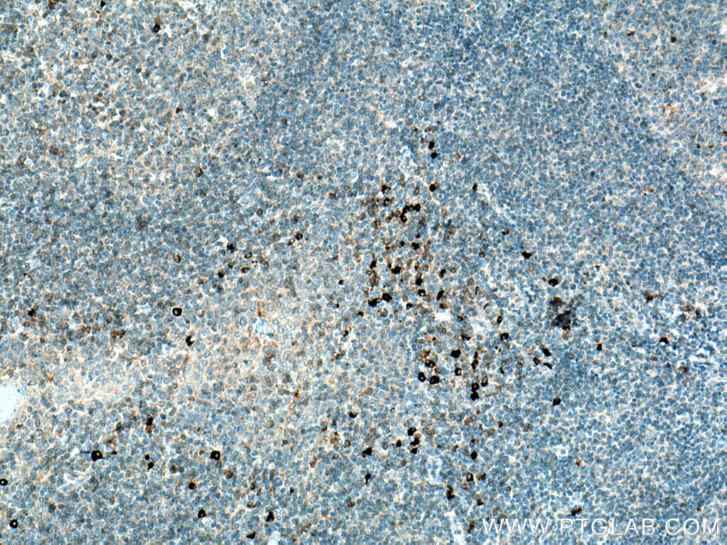 Immunohistochemistry (IHC) staining of human tonsillitis tissue using IL-28A Polyclonal antibody (22646-1-AP)