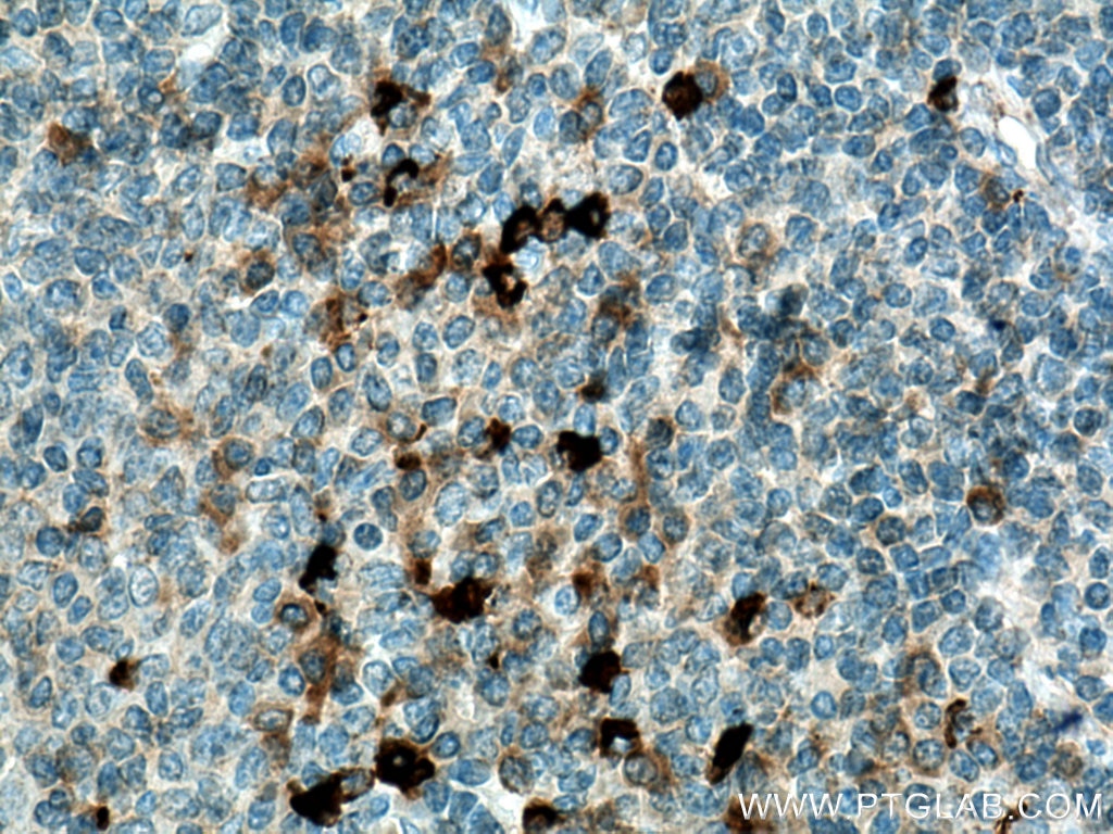 Immunohistochemistry (IHC) staining of human tonsillitis tissue using IL-28A Polyclonal antibody (22646-1-AP)