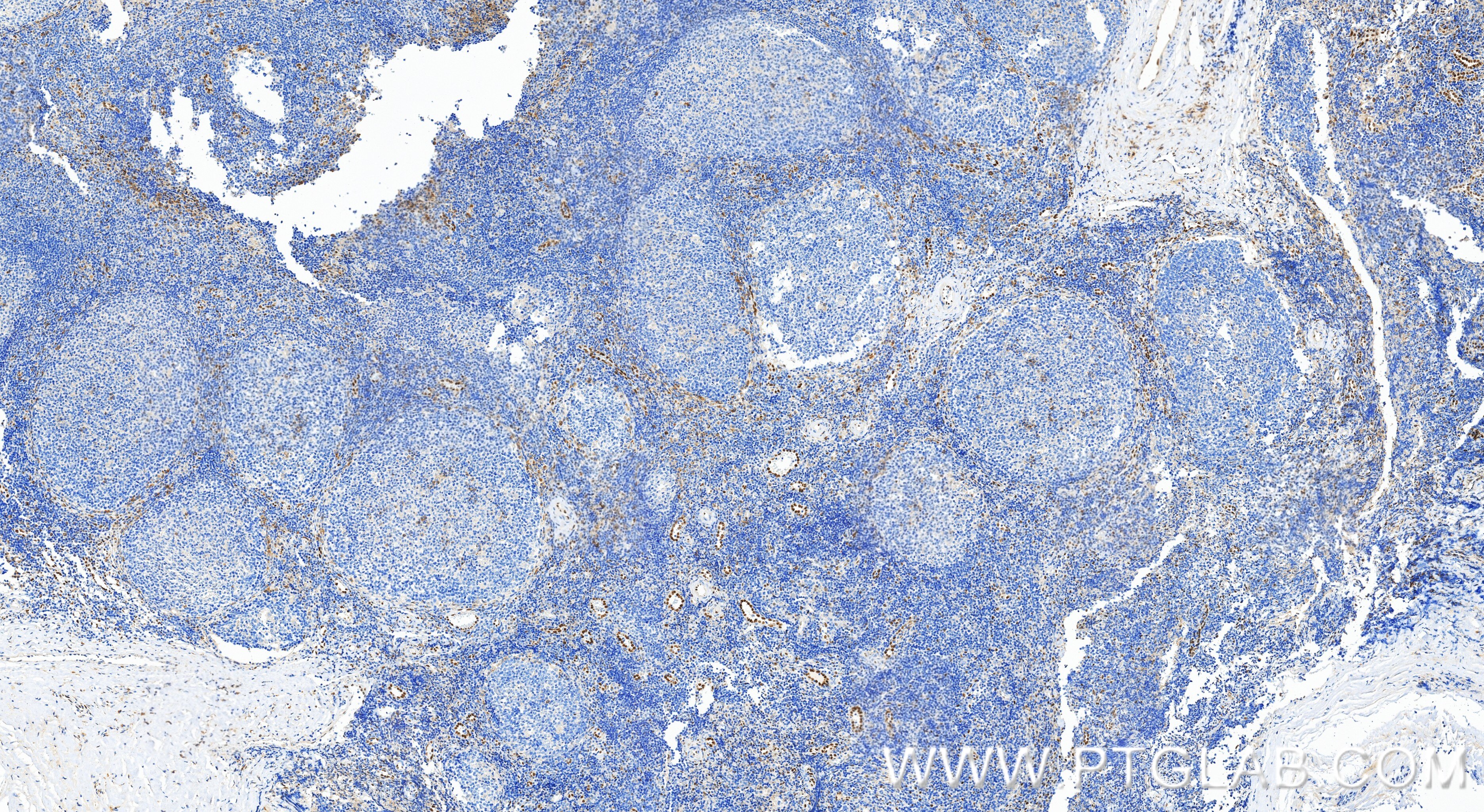 IHC staining of human tonsillitis using 83765-7-RR Immunohistochemistry (IHC) staining of human tonsillitis tissue using IL-33 Recombinant monoclonal antibody (83765-7-RR)