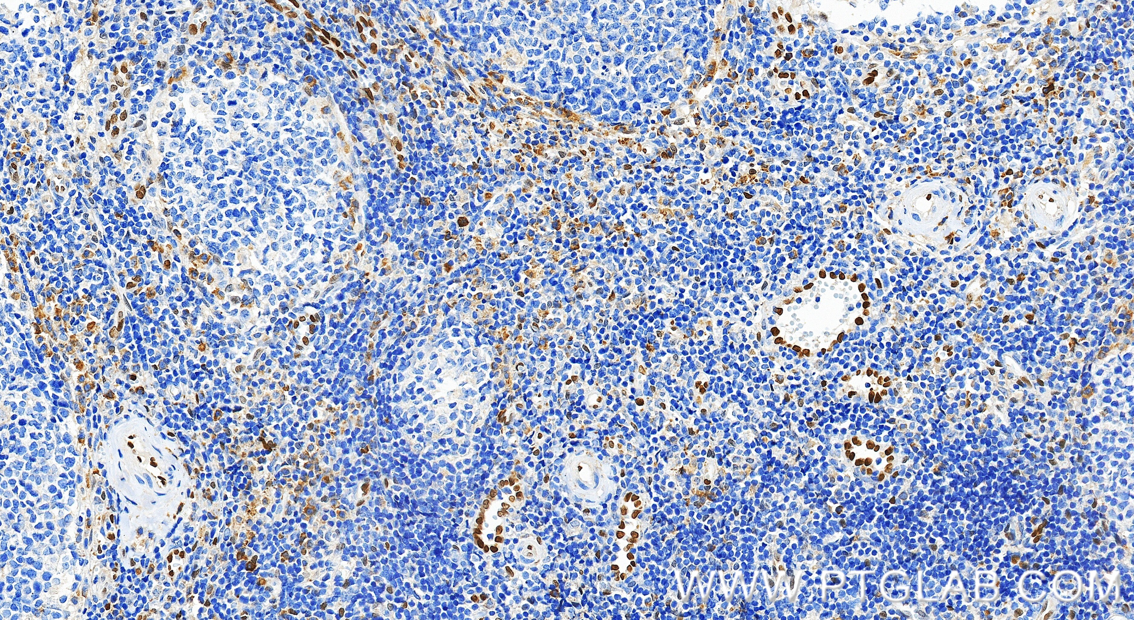 IHC staining of human tonsillitis using 83765-7-RR Immunohistochemistry (IHC) staining of human tonsillitis tissue using IL-33 Recombinant monoclonal antibody (83765-7-RR)