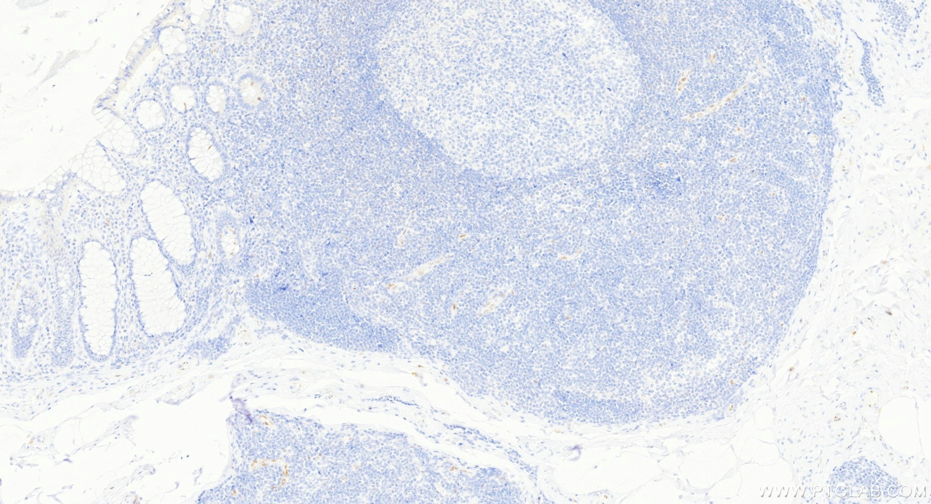 Immunohistochemistry (IHC) staining of human colon tissue using Anti-Human IL-33 Rabbit Recombinant Antibody (98364-2-RR)
