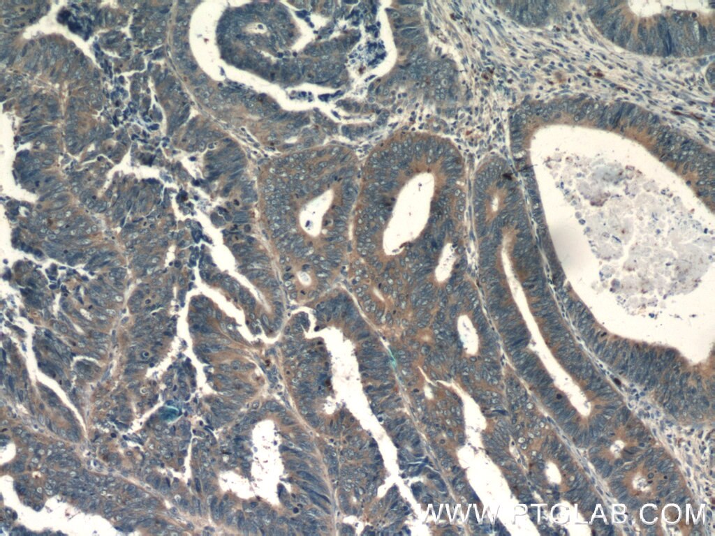 Immunohistochemistry (IHC) staining of human colon cancer tissue using IL-36 Gamma Polyclonal antibody (21255-1-AP)