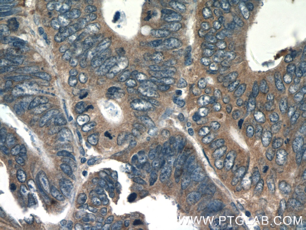 Immunohistochemistry (IHC) staining of human colon cancer tissue using IL-36 Gamma Polyclonal antibody (21255-1-AP)