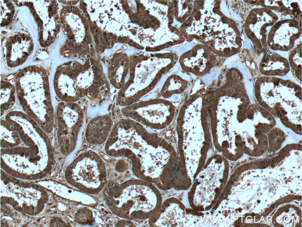 Immunohistochemistry (IHC) staining of human ovary tumor tissue using IL-36 Gamma Polyclonal antibody (24723-1-AP)