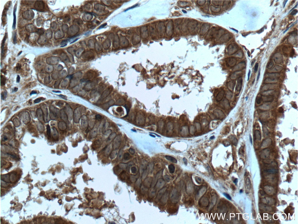 Immunohistochemistry (IHC) staining of human ovary tumor tissue using IL-36 Gamma Polyclonal antibody (24723-1-AP)