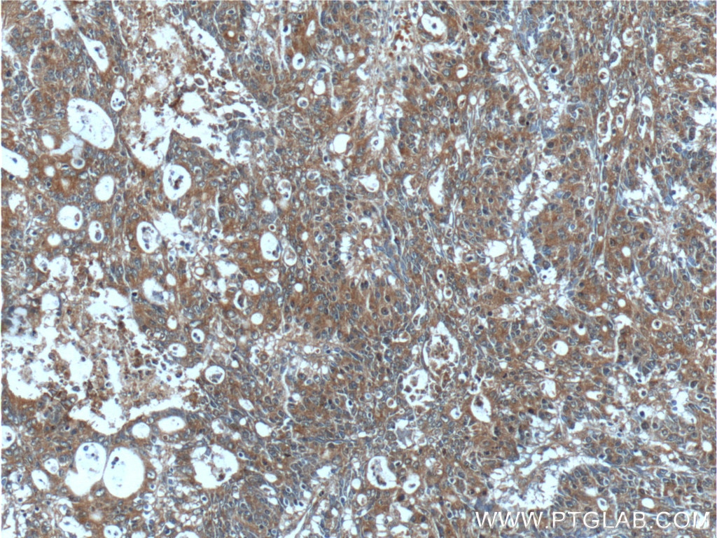 IHC staining of human colon cancer using 24723-1-AP