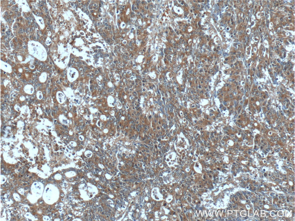 Immunohistochemistry (IHC) staining of human colon cancer tissue using IL-36 Gamma Polyclonal antibody (24723-1-AP)