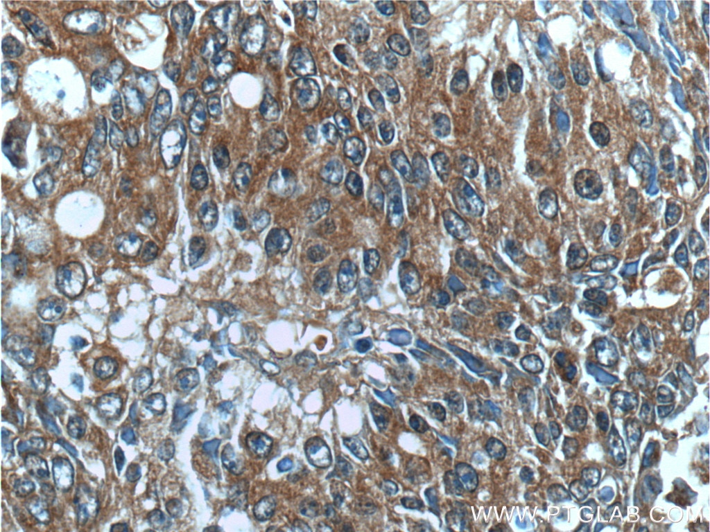 Immunohistochemistry (IHC) staining of human colon cancer tissue using IL-36 Gamma Polyclonal antibody (24723-1-AP)