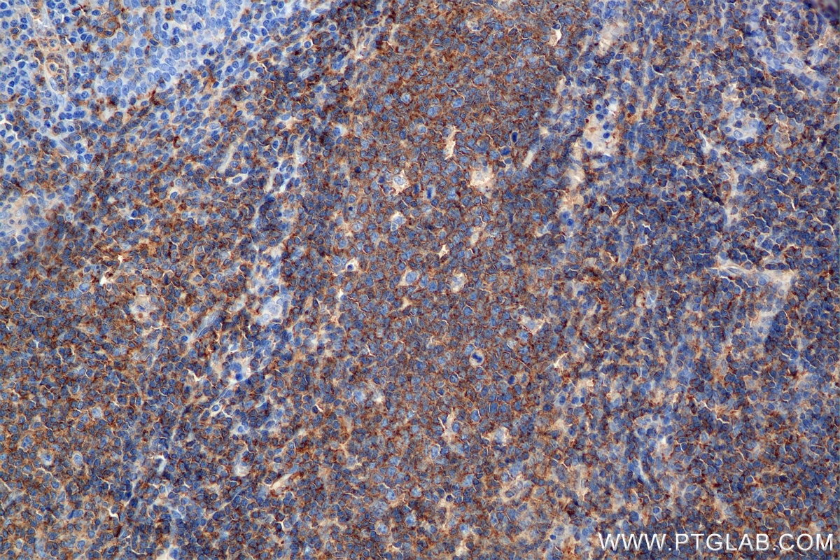 Immunohistochemical analysis of paraffin-embedded human tonsil tissue slide using 84758-5-RR (IL-4RA/CD124 antibody) at dilution of 1:1000 (under 40x lens). Heat mediated antigen retrieval with Tris-EDTA buffer (pH 9.0). This data was developed using the same antibody clone with 84758-5-PBS in a different storage buffer formulation. Immunohistochemistry (IHC) staining of human tonsil tissue using IL-4RA/CD124 Recombinant monoclonal antibody (84758-5-RR)