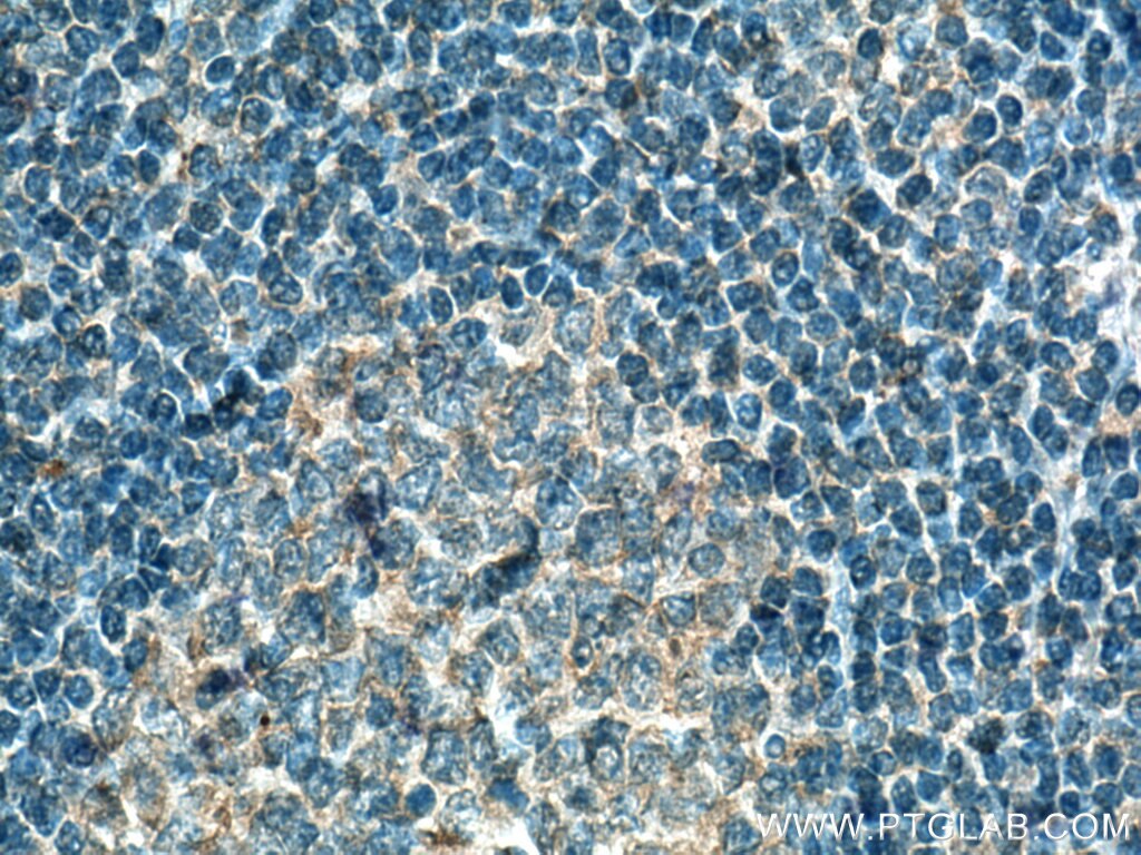 Immunohistochemistry (IHC) staining of human tonsillitis tissue using NeutraKine® IL-6 Monoclonal antibody (69001-1-Ig)