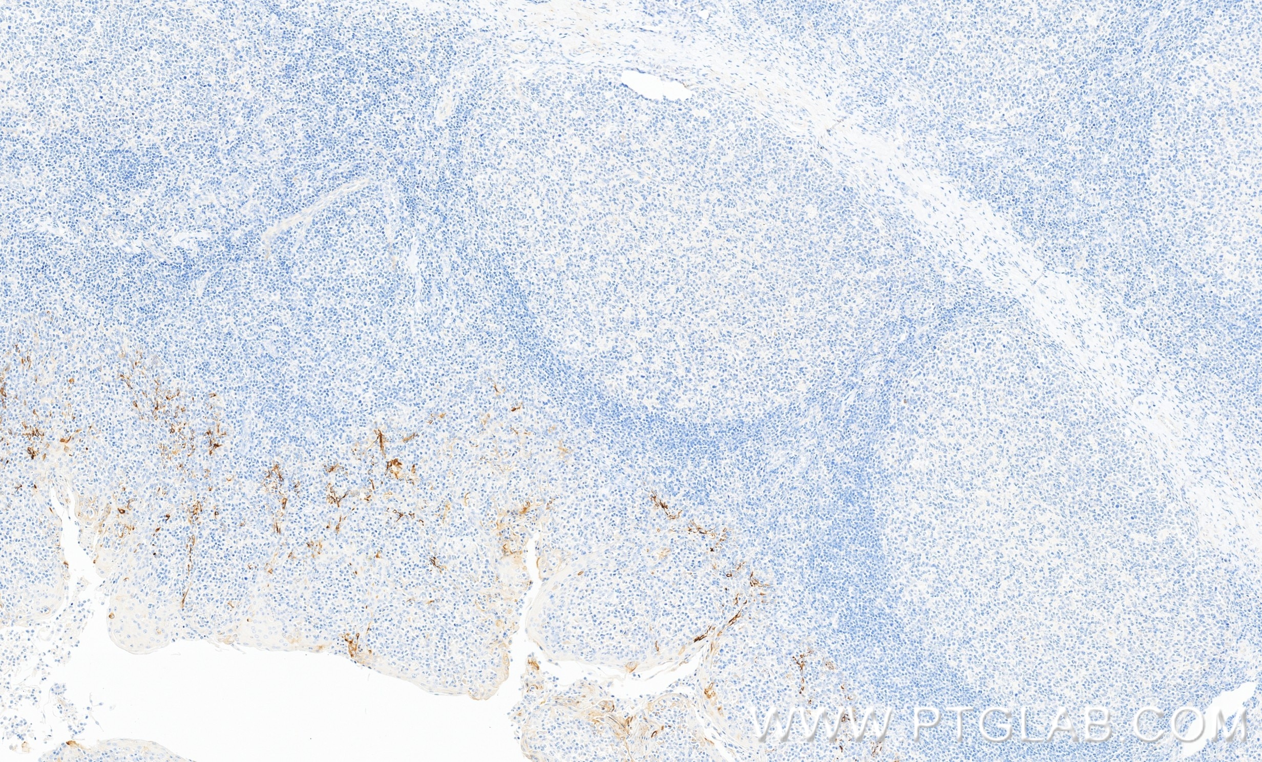 Immunohistochemistry (IHC) staining of human tonsillitis tissue using IL-7 Recombinant monoclonal antibody (84165-5-RR)