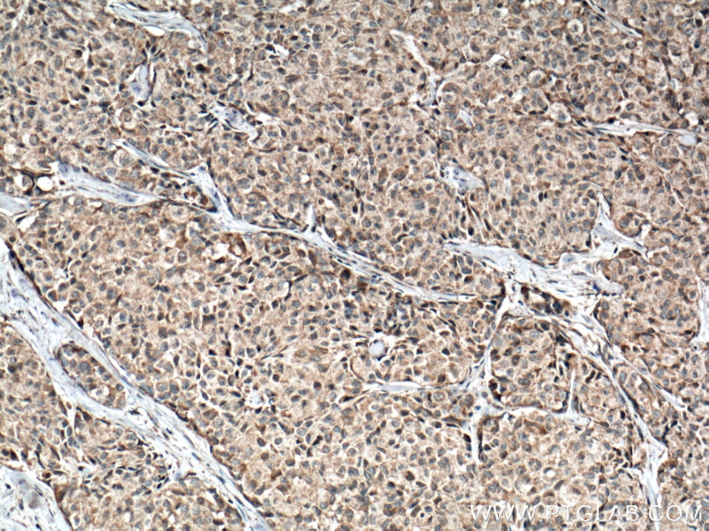 Immunohistochemistry (IHC) staining of human lung cancer tissue using IL-1 Beta Monoclonal antibody (66737-1-Ig)