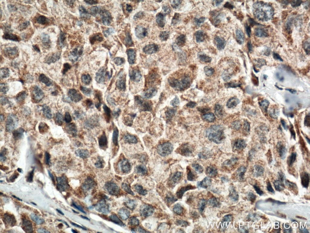 Immunohistochemistry (IHC) staining of human lung cancer tissue using IL-1 Beta Monoclonal antibody (66737-1-Ig)