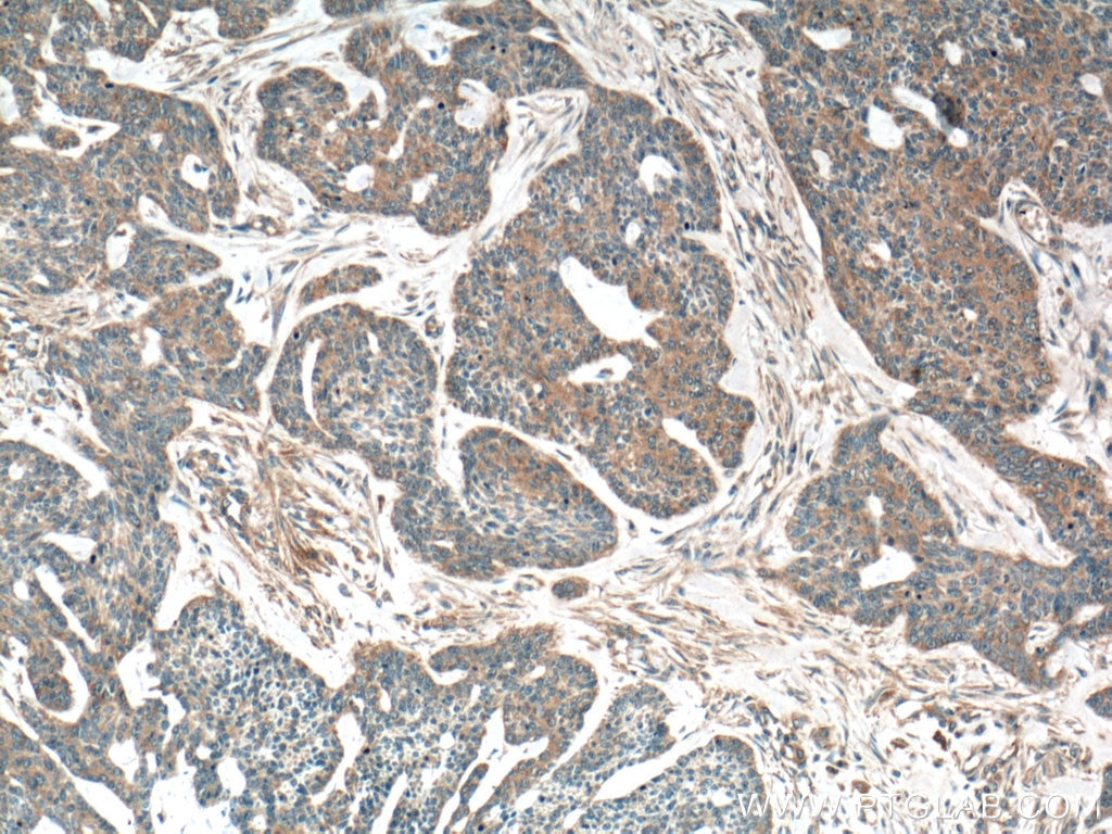 IHC staining of human skin cancer using 66737-1-Ig