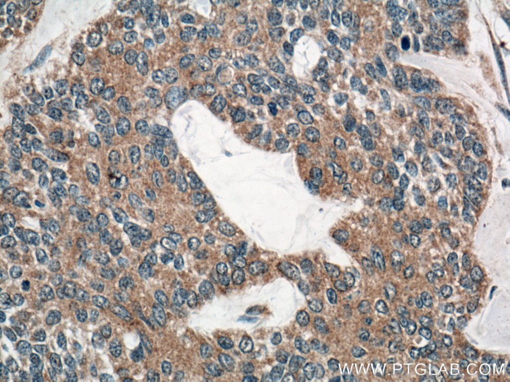 Immunohistochemistry (IHC) staining of human skin cancer tissue using IL-1 Beta Monoclonal antibody (66737-1-Ig)