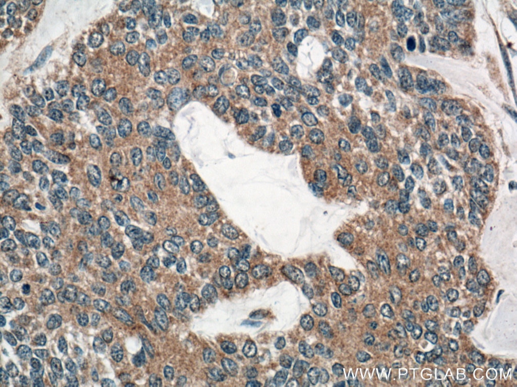 IHC staining of human skin cancer using 66737-1-Ig