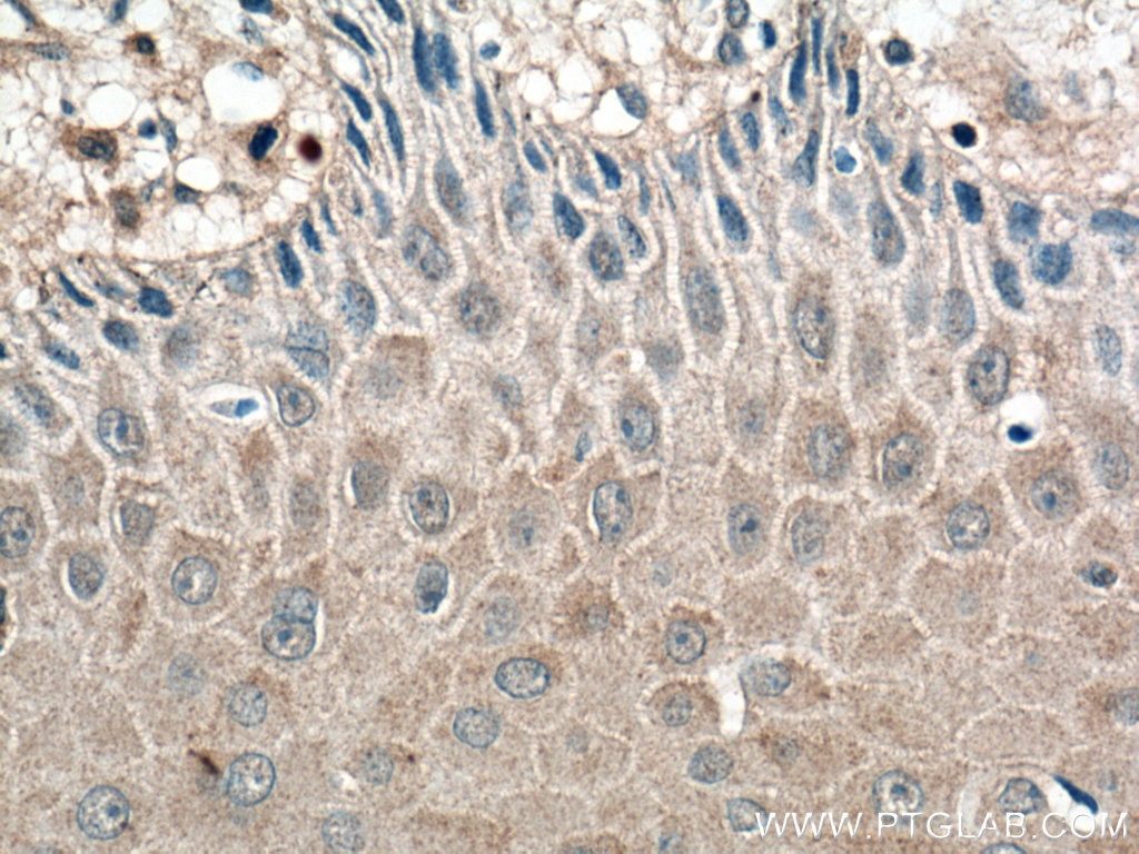 Immunohistochemistry (IHC) staining of human skin cancer tissue using IL-1 Beta Monoclonal antibody (66737-1-Ig)