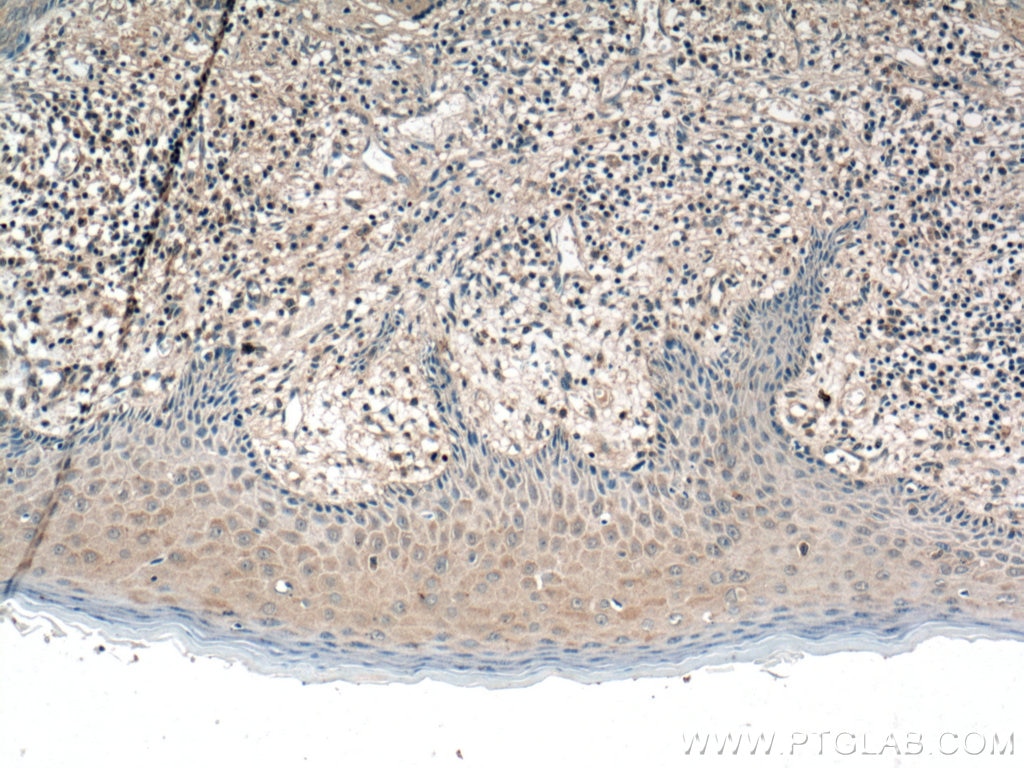 Immunohistochemistry (IHC) staining of human skin cancer tissue using IL-1 Beta Monoclonal antibody (66737-1-Ig)