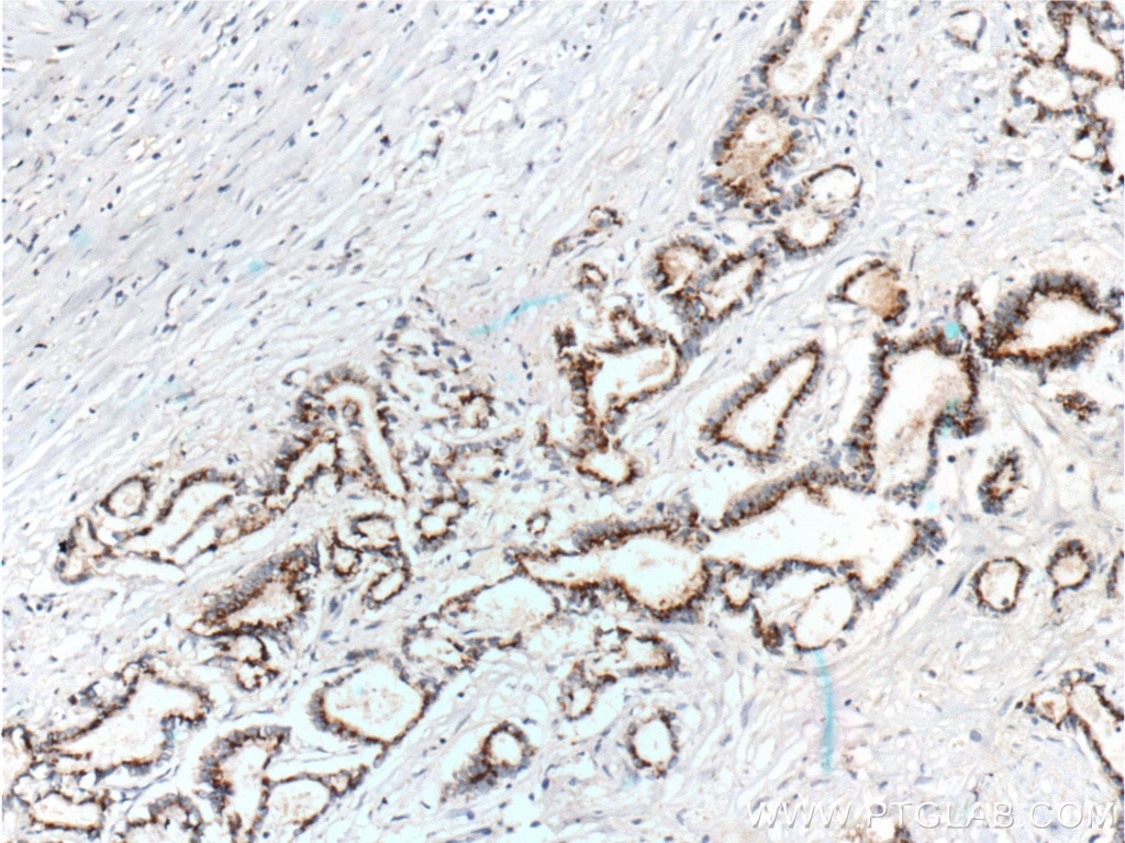 Immunohistochemistry (IHC) staining of human pancreas cancer tissue using IL-10 Monoclonal antibody (60269-1-Ig)