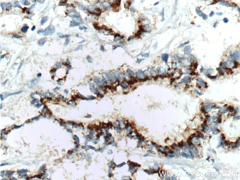 IHC staining of human pancreas cancer using 60269-1-Ig