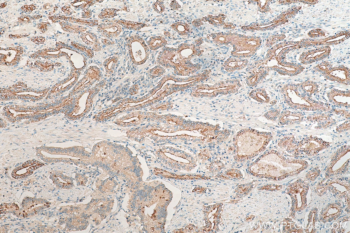 Immunohistochemistry (IHC) staining of human prostate cancer tissue using IL-11RA Polyclonal antibody (10264-1-AP)
