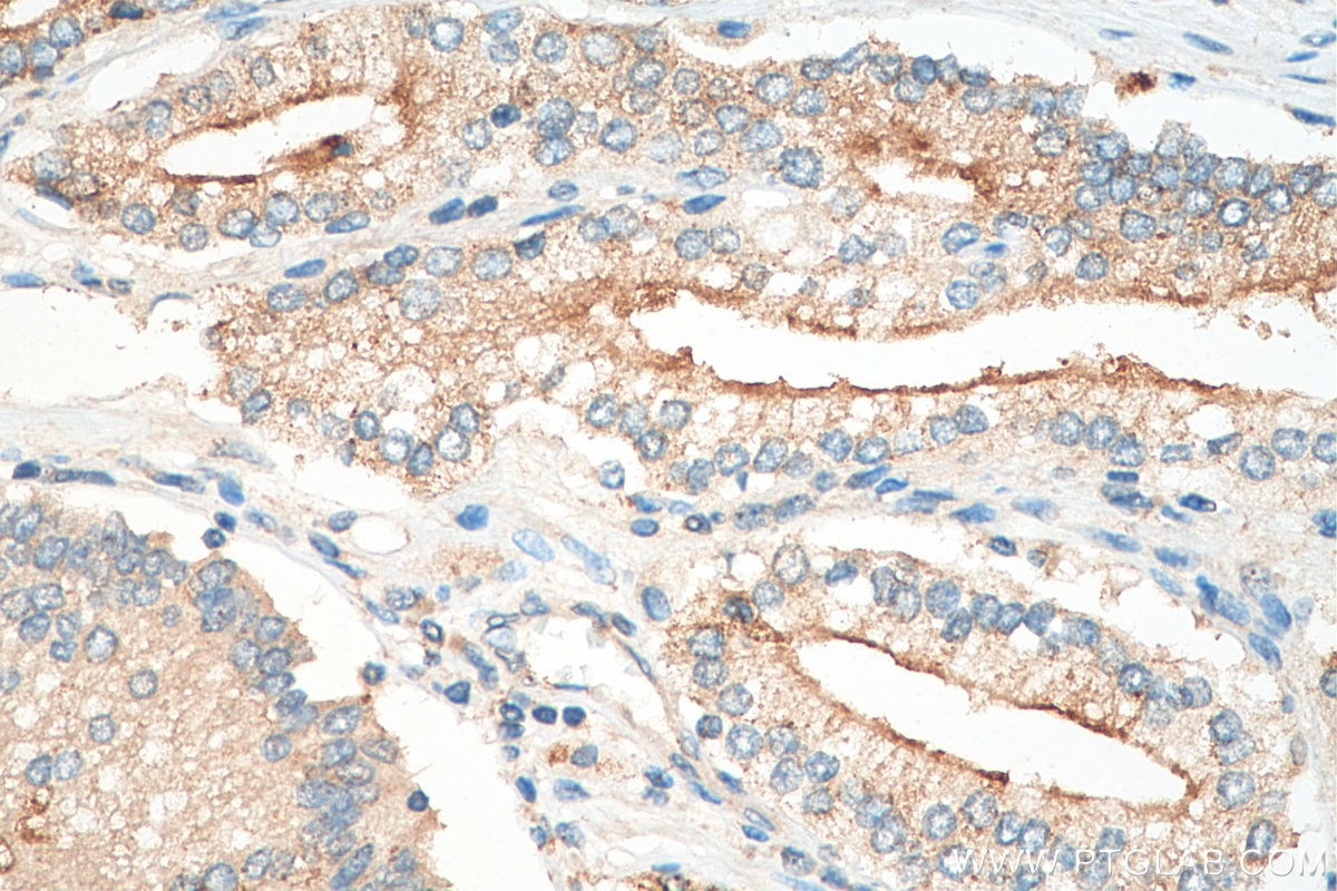 Immunohistochemistry (IHC) staining of human prostate cancer tissue using IL-11RA Polyclonal antibody (10264-1-AP)