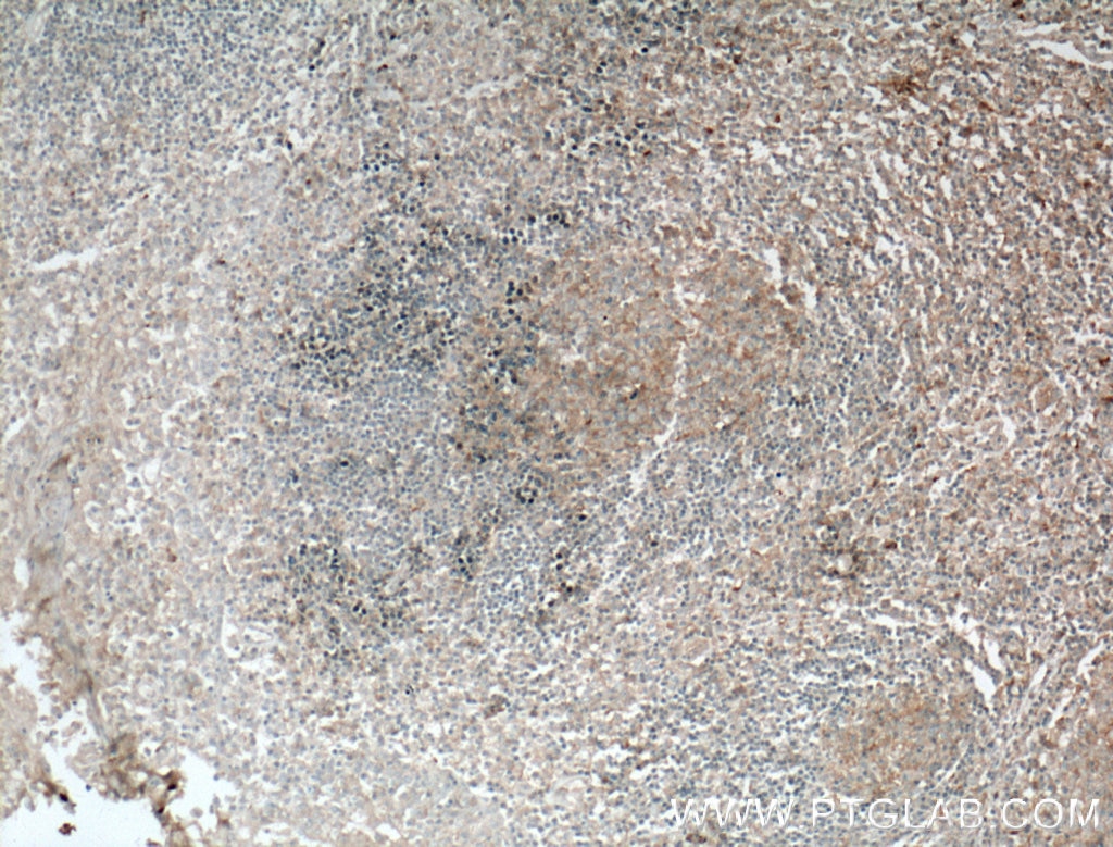 Immunohistochemistry (IHC) staining of human tonsillitis tissue using IL-12A Monoclonal antibody (60324-1-Ig)