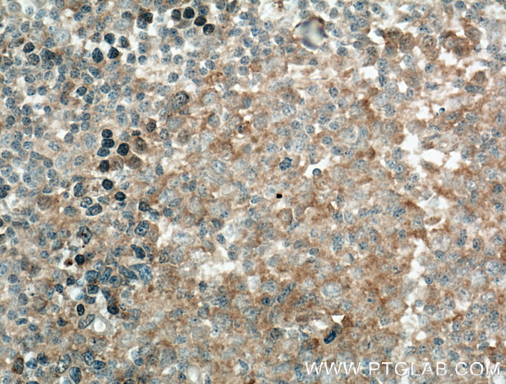 Immunohistochemistry (IHC) staining of human tonsillitis tissue using IL-12A Monoclonal antibody (60324-1-Ig)