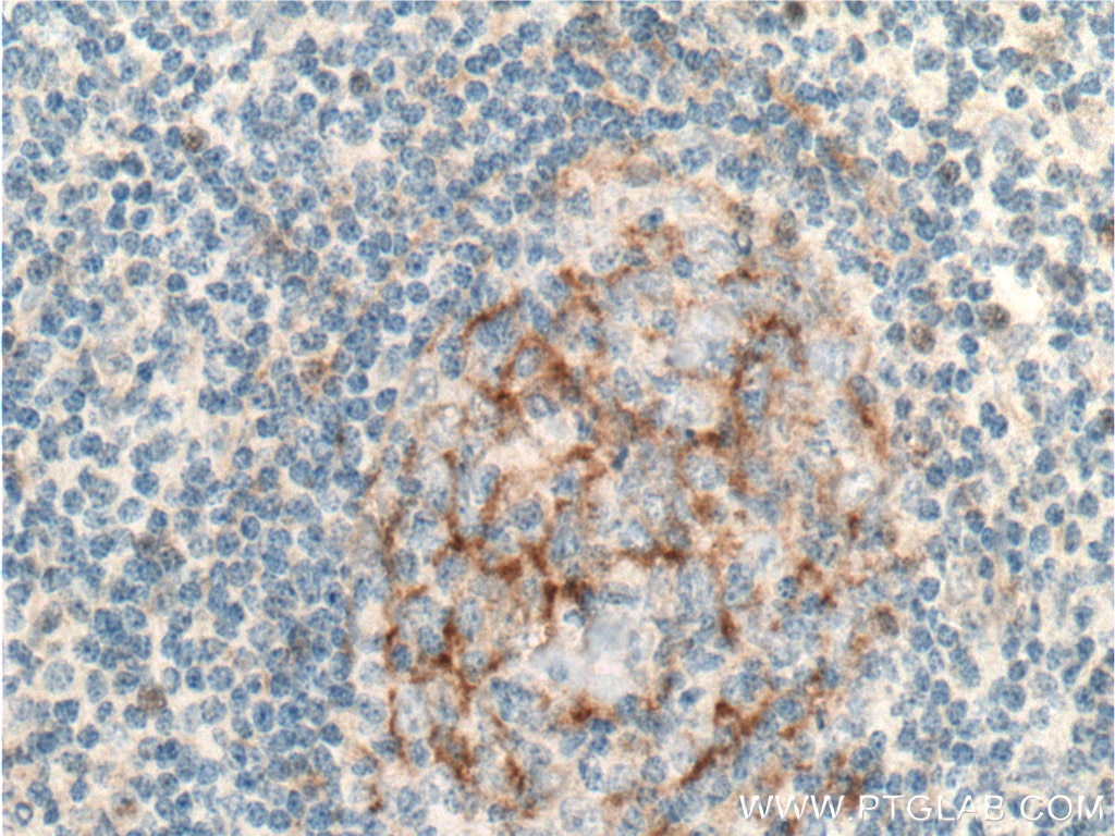 Immunohistochemistry (IHC) staining of human tonsillitis tissue using IL-12RB1 Polyclonal antibody (13287-1-AP)