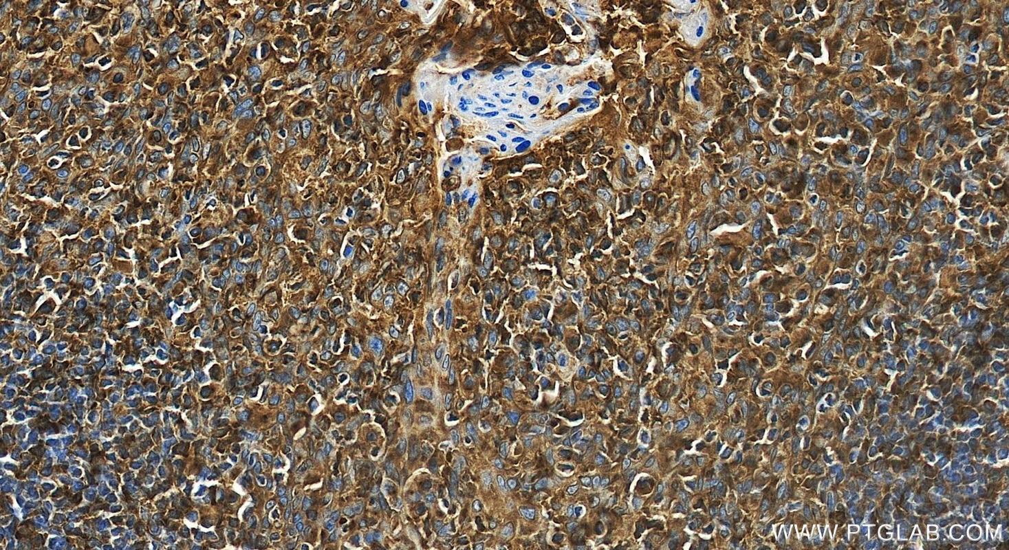 Immunohistochemistry (IHC) staining of human tonsillitis tissue using IL-12RB1/CD212 Recombinant monoclonal antibody (84391-4-RR)