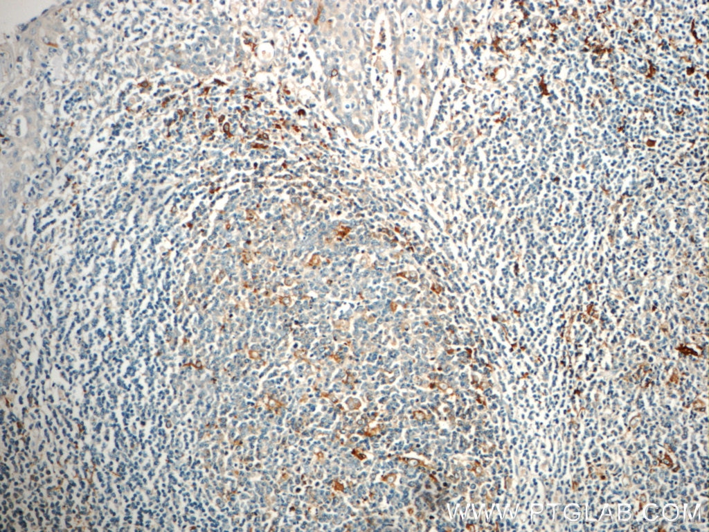 Immunohistochemistry (IHC) staining of human tonsillitis tissue using IL-13 Polyclonal antibody (22085-1-AP)