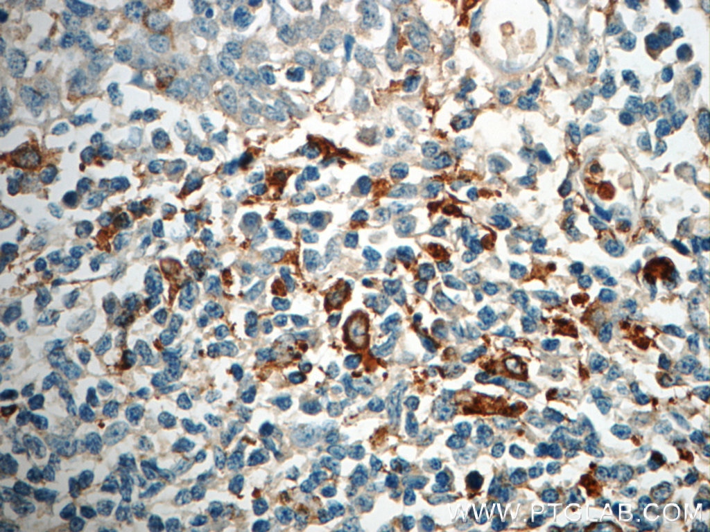 IHC staining of human tonsillitis using 22085-1-AP