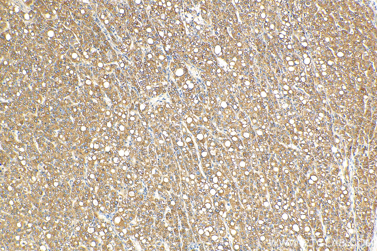 Immunohistochemistry (IHC) staining of human liver cancer tissue using IL-13RA2 Polyclonal antibody (11059-1-AP)
