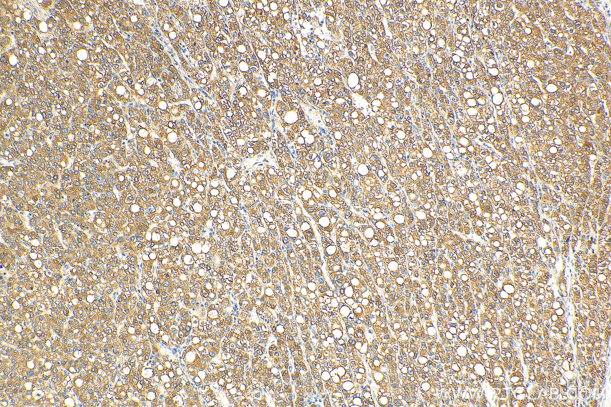 IHC staining of human liver cancer using 11059-1-AP