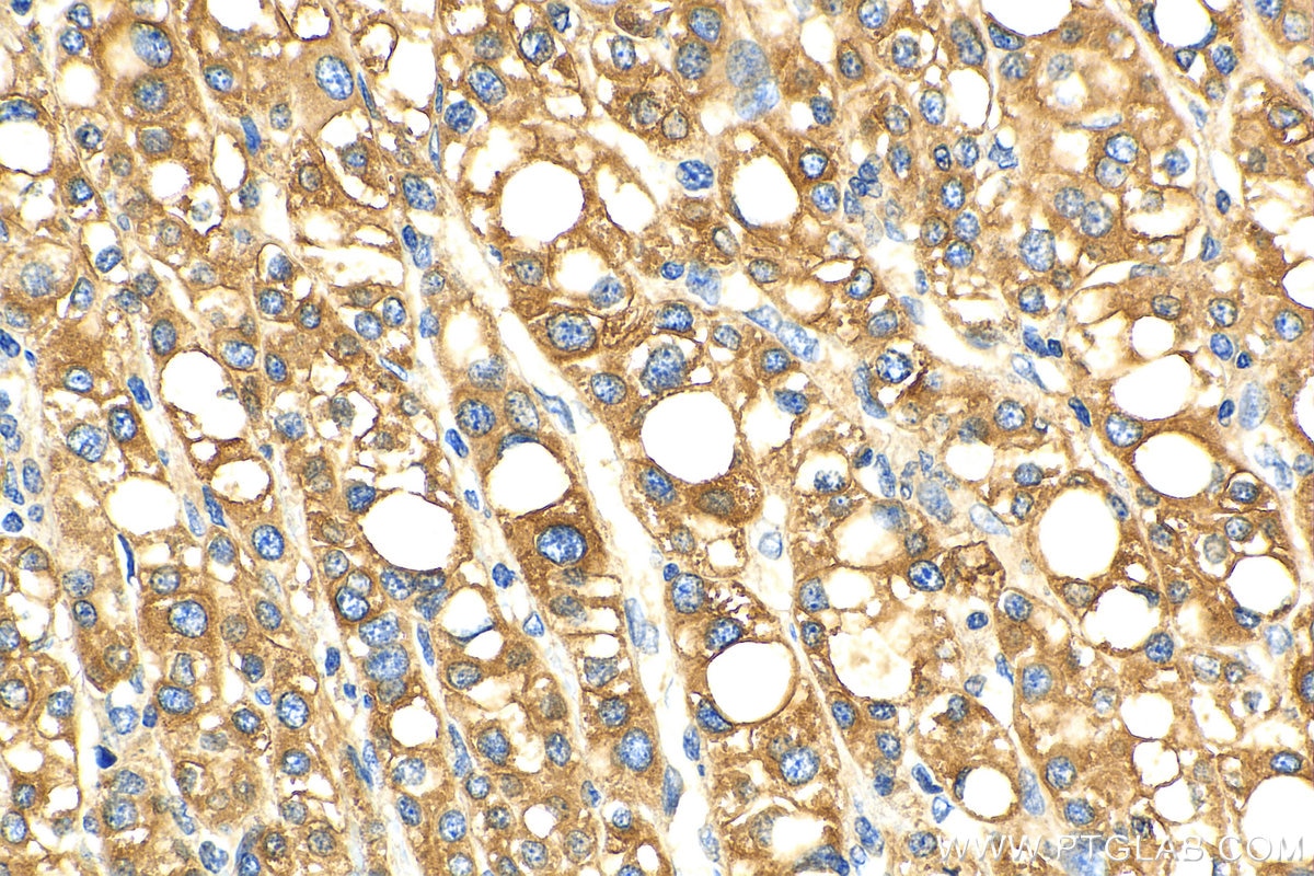 Immunohistochemistry (IHC) staining of human liver cancer tissue using IL-13RA2 Polyclonal antibody (11059-1-AP)